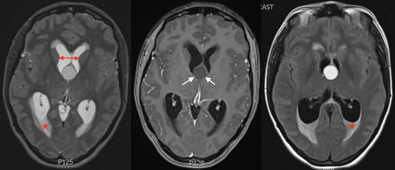 colloid brain cyst icd 10