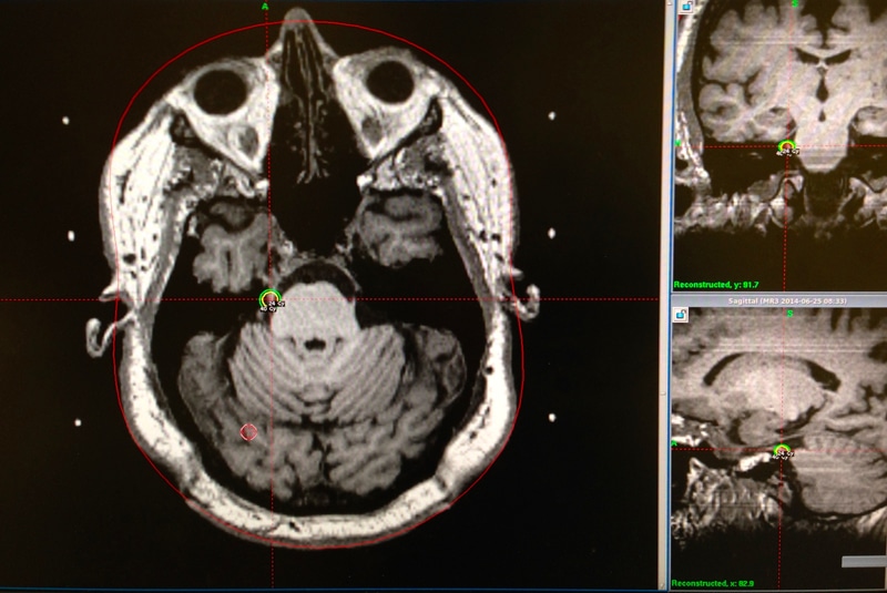 Gamma Knife Radiosurgery For Trigeminal Neuralgia 0845